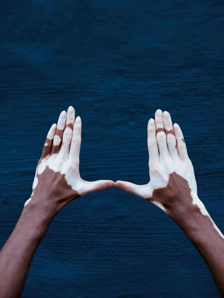 hands with vitiligo above blue sea 